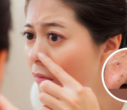Blackheads සහ Whiteheads ඉක්මනින් ඉවත්කර ගැනීමට ස්වාභාවික ක්රම මෙන්න..